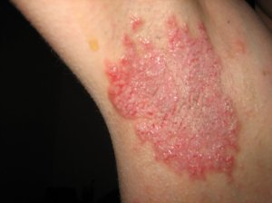 underarm rash